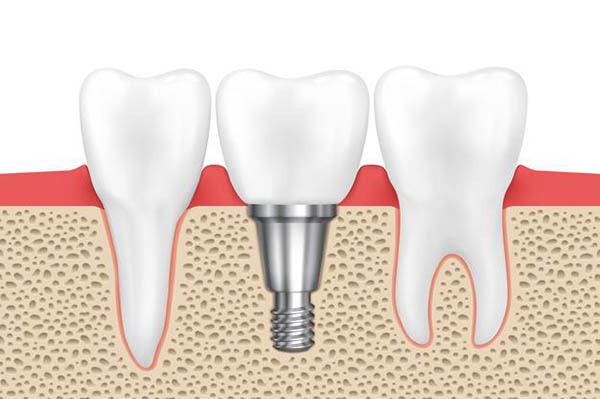 Почему зубной имплант отторгается. Основные причины